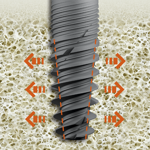 IMG Implants naturactis conicite
